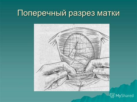Влияние кесарева сечения на ходьбу по лестнице
