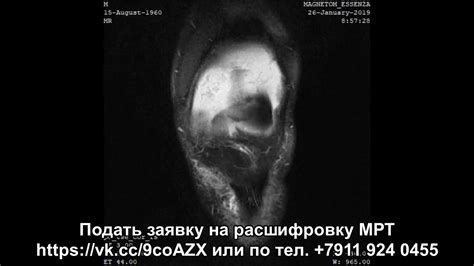 Особенности парного процесса для пациентов с кистой Бейкера