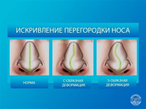 Решение проблемы с утканьем носа в кровать