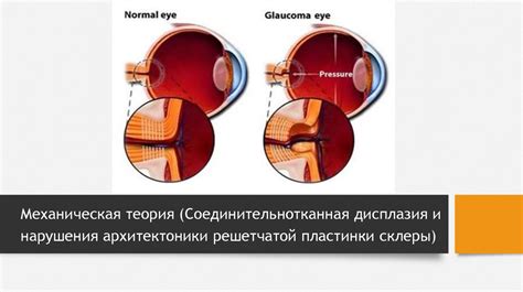 Роль кофе в развитии глаукомы