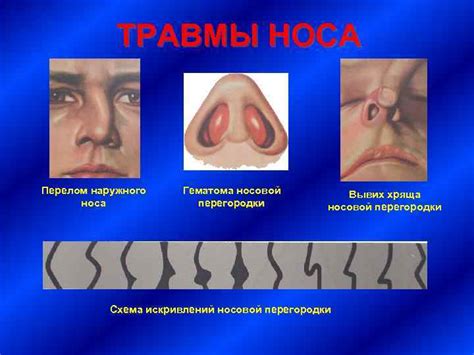 Травма носа