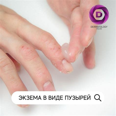 Причины образования пузырей на гидрогелевой пленке