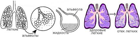 Физиологические аспекты и причины развития отека легких