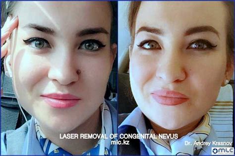 Влияние лунного цикла на процесс удаления родинок