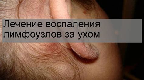 Причины возникновения воспаления лимфоузла