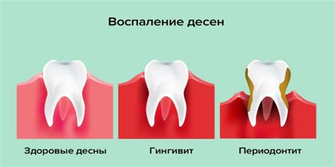 Воспаление десен: симптомы и лечение