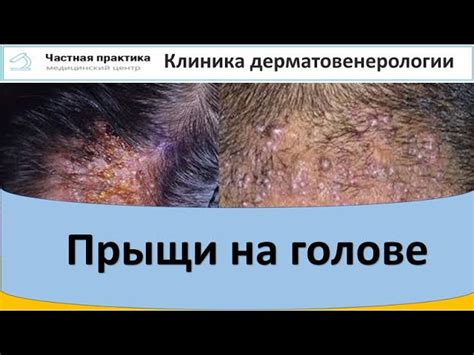 Генетические причины полумесяца на голове