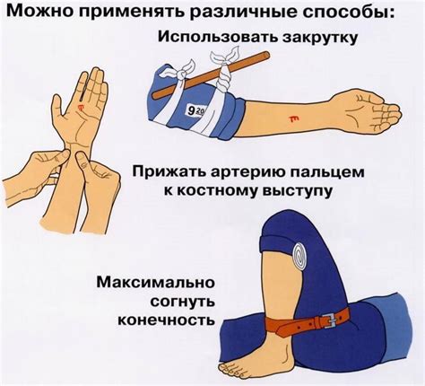 Использование пряжки для остановки кровотечения