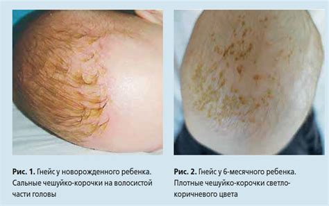 Как убрать полумесяц на голове у ребенка