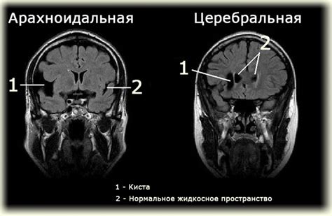 Симптомы обызвествления фалькса головного мозга