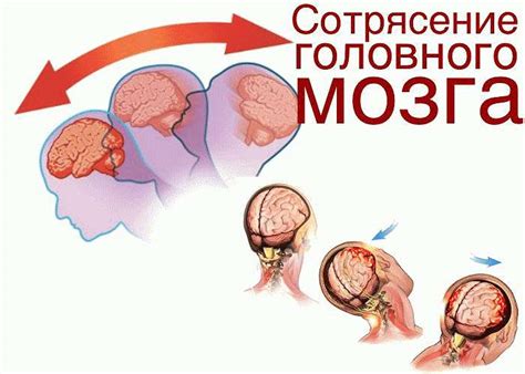  Причины обызвествления фалькса головного мозга 