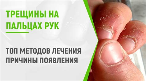 Зачем удалять грязь с рук в трещинах
