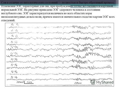 Изменения ирритативного характера на ЭЭГ
