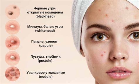 Как лечить прыщи с желтой жидкостью
