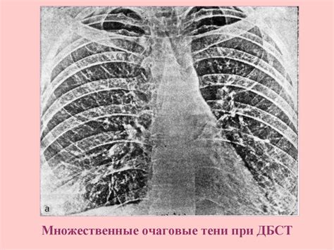Лечение ТБК легких
