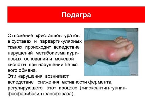 Отложение кристаллов и камней в суставах