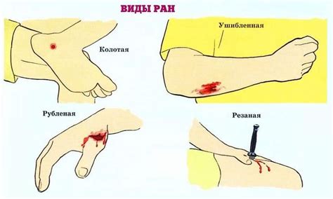 Рана или травма