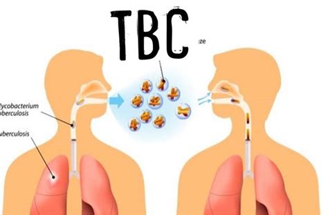 Расшифровка TBC легких