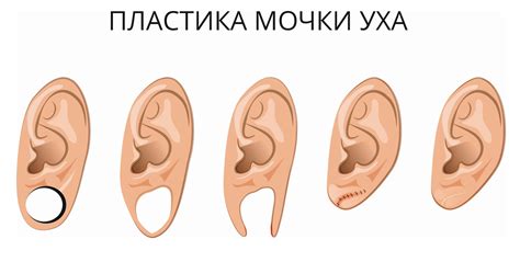 Способы уменьшить дырку в ухе без хирургического вмешательства