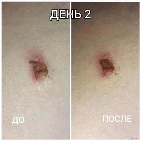 Что нельзя делать при загнивании шва после лапароскопии