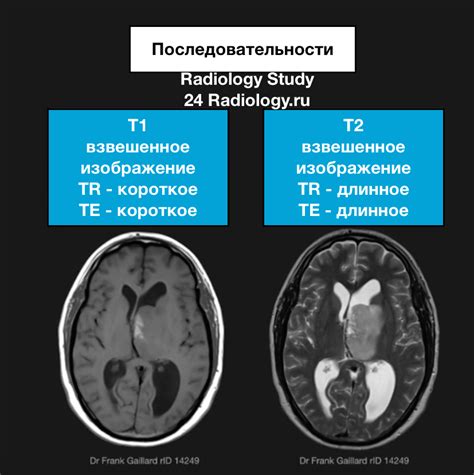 Что такое МР-сигнал и его роль в медицине
