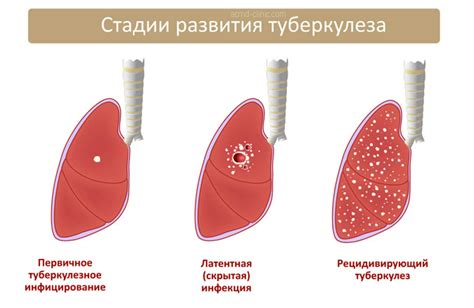 Что такое TBC легких