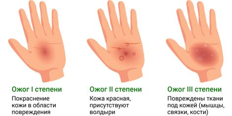 Как избежать ожога от веррукацида