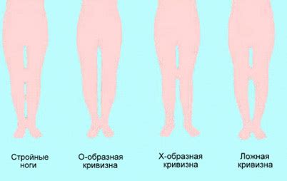 Как исправить положение ноги