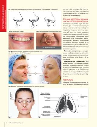 Нехирургические методы коррекции длинной шеи