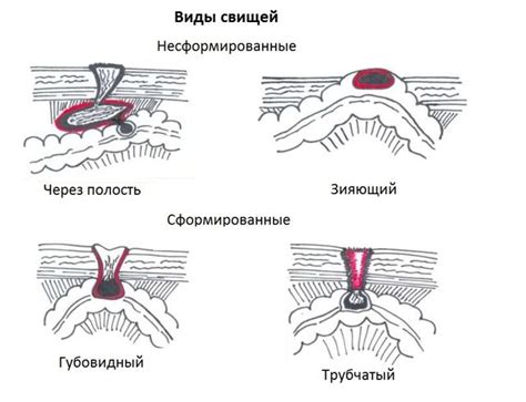 Осложнения лечения танталовых швов на легких