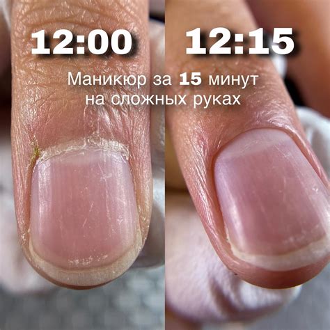 Сразу после обнаружения черного ногтя: первые шаги